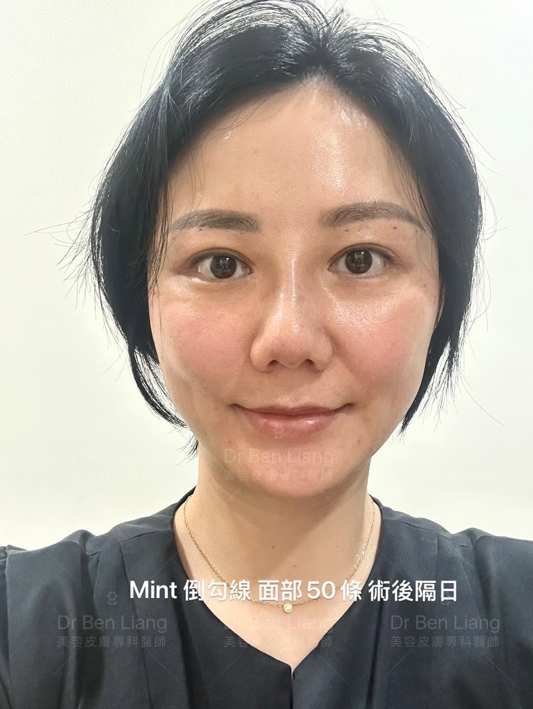 Mint 復位型埋線術後隔日正面自然狀態